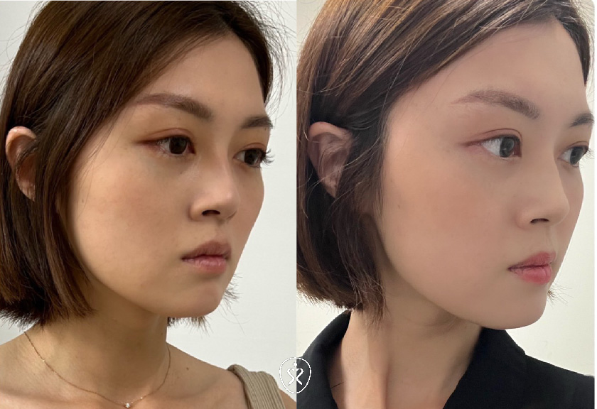 【肉毒瘦小臉】
